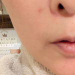 フェイシャル施術前